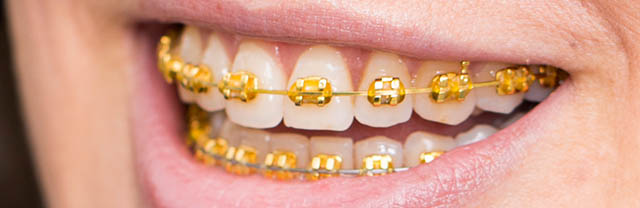 Gold Braces